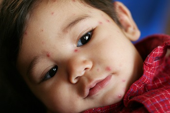 Dealing with Chickenpox