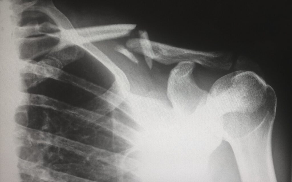Mercy Grace Blog - Broken Bones