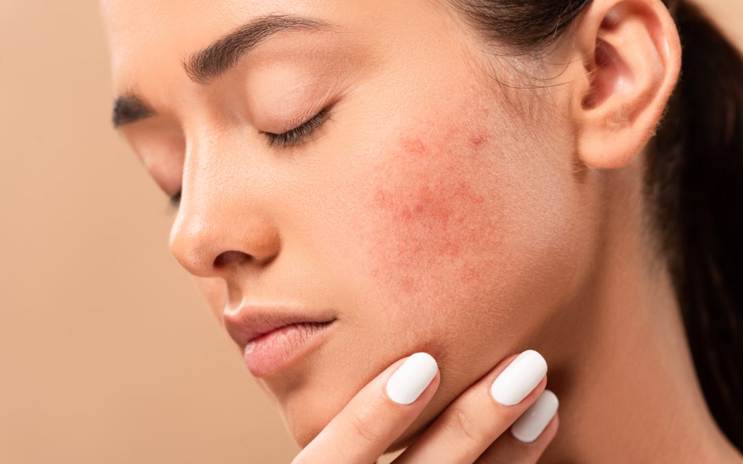 ACNE VULGARIS