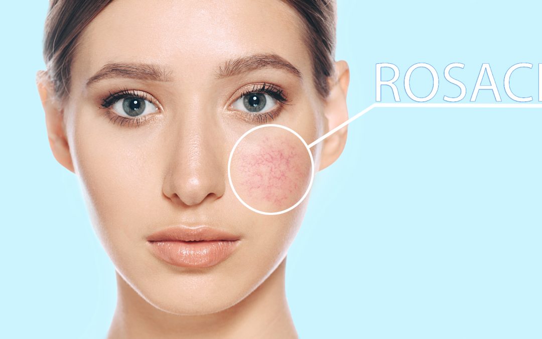 Rosacea