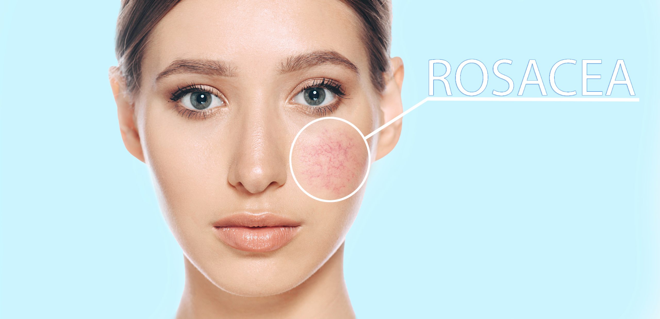rosacea