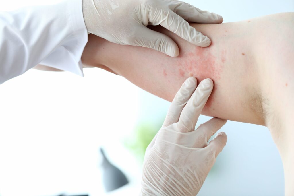 eczema treatment mercy grace aesthetics