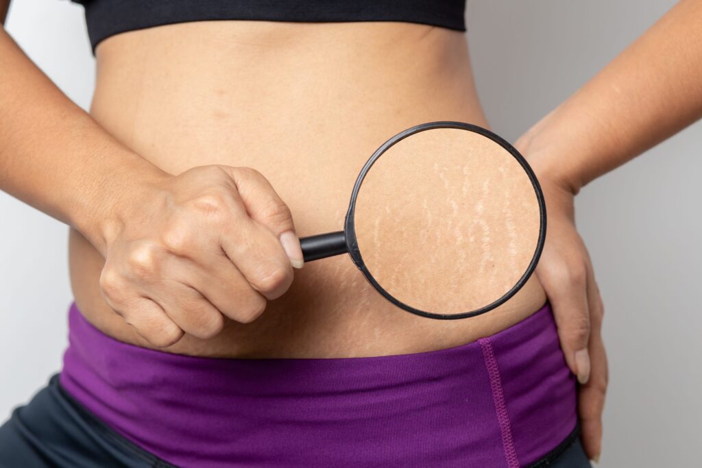 Stretch Marks