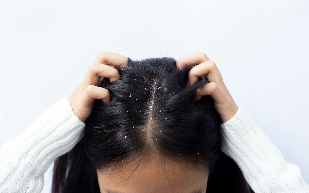 SEBORRHEIC DERMATITIS